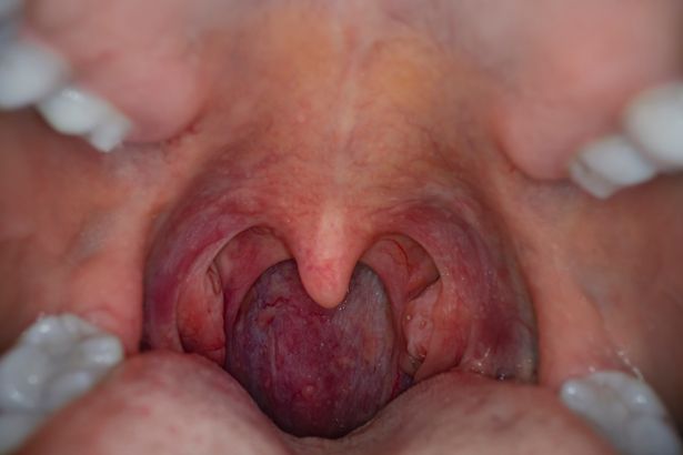 tonsil